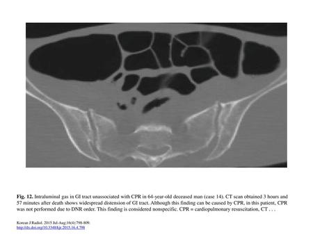 Fig. 12. Intraluminal gas in GI tract unassociated with CPR in 64-year-old deceased man (case 14). CT scan obtained 3 hours and 57 minutes after death.