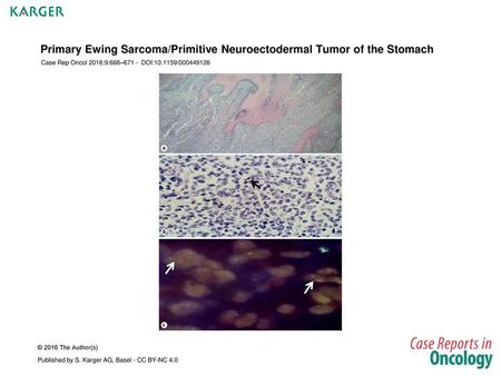 Primary Ewing Sarcoma/Primitive Neuroectodermal Tumor of the Stomach
