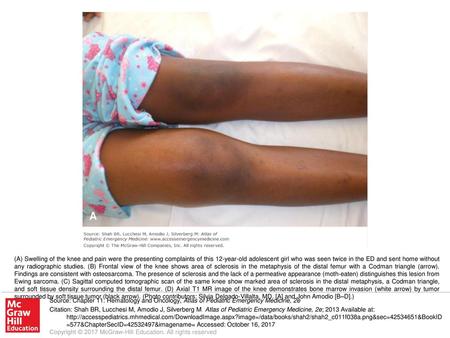 (A) Swelling of the knee and pain were the presenting complaints of this 12-year-old adolescent girl who was seen twice in the ED and sent home without.