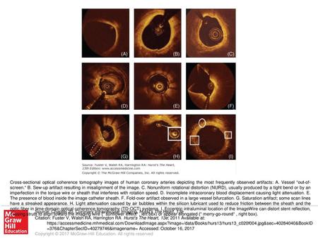Cross-sectional optical coherence tomography images of human coronary arteries depicting the most frequently observed artifacts: A. Vessel “out-of-screen.“