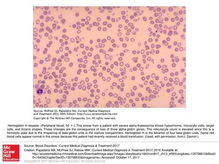 Hemoglobin H disease. (Peripheral blood, 50 ×
