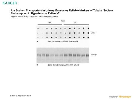 Are Sodium Transporters in Urinary Exosomes Reliable Markers of Tubular Sodium Reabsorption in Hypertensive Patients? Nephron Physiol 2010;114:p25–p34.