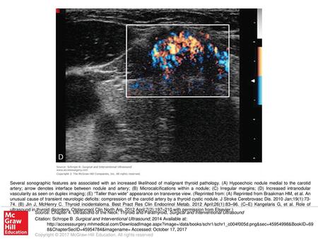 Several sonographic features are associated with an increased likelihood of malignant thyroid pathology. (A) Hypoechoic nodule medial to the carotid artery;