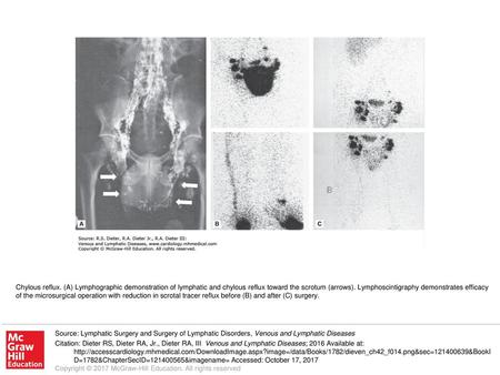 Chylous reflux. (A) Lymphographic demonstration of lymphatic and chylous reflux toward the scrotum (arrows). Lymphoscintigraphy demonstrates efficacy of.