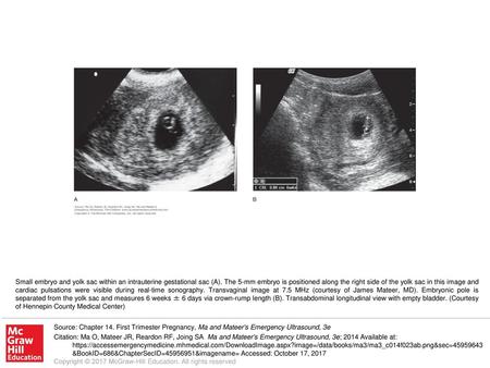 Small embryo and yolk sac within an intrauterine gestational sac (A)