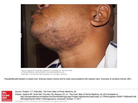 Pseudofolliculitis barbae in a black man