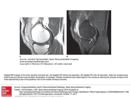 Sagittal MR images of the knee showing meniscal tear