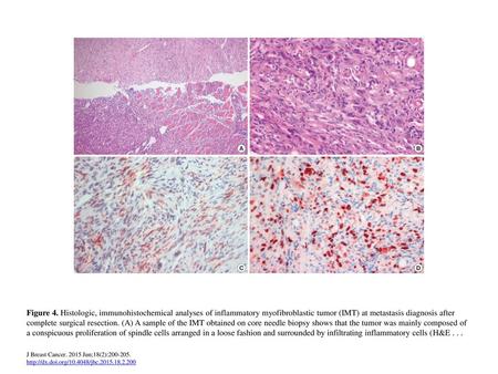 Figure 4. Histologic, immunohistochemical analyses of inflammatory myofibroblastic tumor (IMT) at metastasis diagnosis after complete surgical resection.