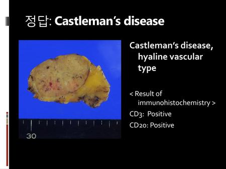 정답: Castleman’s disease