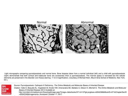 Light micrographs comparing pycnodysostosis and normal bone