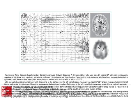 Generalized, frontally predominant, rhythmic fast activity is the most common ictal EEG accompaniment of generalized tonic seizures. Ictal EEG patterns.