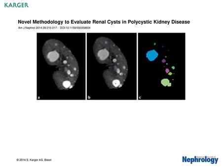 Novel Methodology to Evaluate Renal Cysts in Polycystic Kidney Disease
