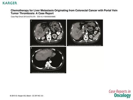 Chemotherapy for Liver Metastasis Originating from Colorectal Cancer with Portal Vein Tumor Thrombosis: A Case Report Case Rep Oncol 2013;6:275-279 -