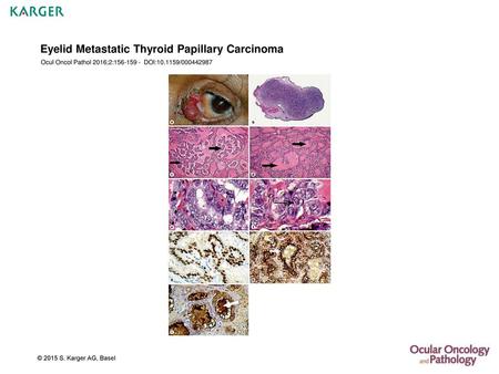 Eyelid Metastatic Thyroid Papillary Carcinoma