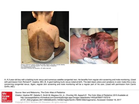 A. A 2-year-old boy with a bathing trunk nevus and numerous satellite congenital nevi. He benefits from regular skin screening and mole monitoring. (Used.