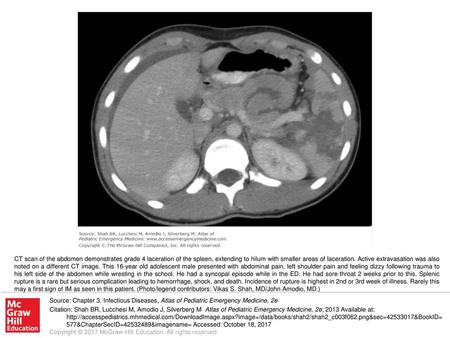 CT scan of the abdomen demonstrates grade 4 laceration of the spleen, extending to hilum with smaller areas of laceration. Active extravasation was also.