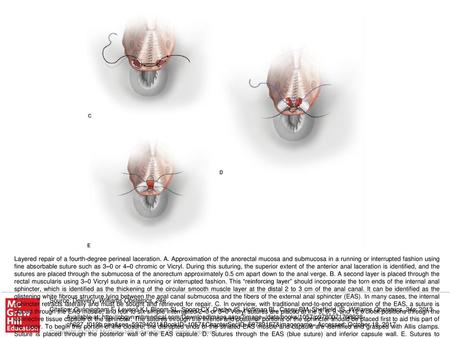 Layered repair of a fourth-degree perineal laceration. A