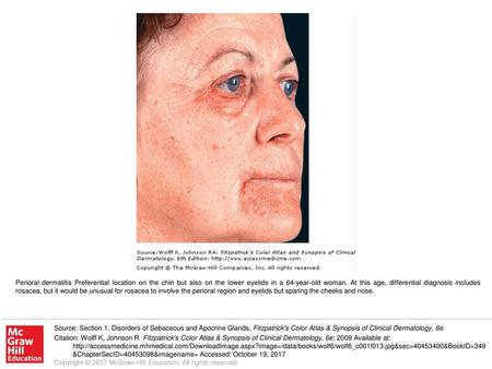 Perioral dermatitis Preferential location on the chin but also on the lower eyelids in a 64-year-old woman. At this age, differential diagnosis includes.