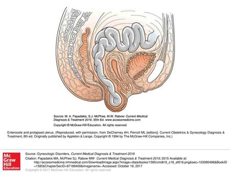 Enterocele and prolapsed uterus