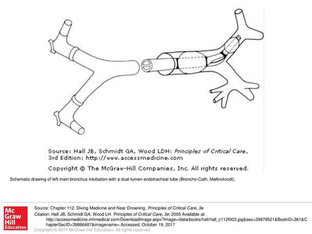 Schematic drawing of left main bronchus intubation with a dual-lumen endotracheal tube (Broncho-Cath, Mallinckrodt). Source: Chapter 112. Diving Medicine.