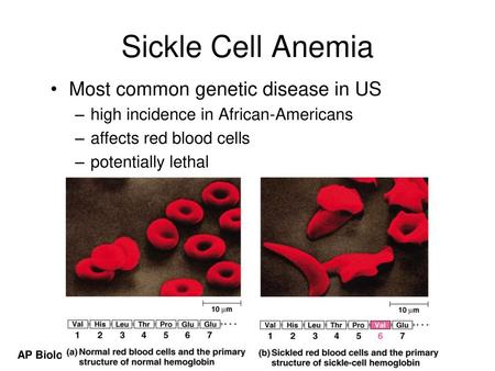 Sickle Cell Anemia Most common genetic disease in US