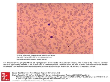 Iron deficiency anemia. (Peripheral blood, 50 ×