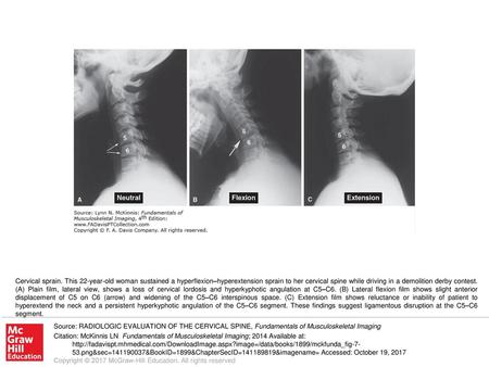 Cervical sprain. This 22-year-old woman sustained a hyperflexion–hyperextension sprain to her cervical spine while driving in a demolition derby contest.