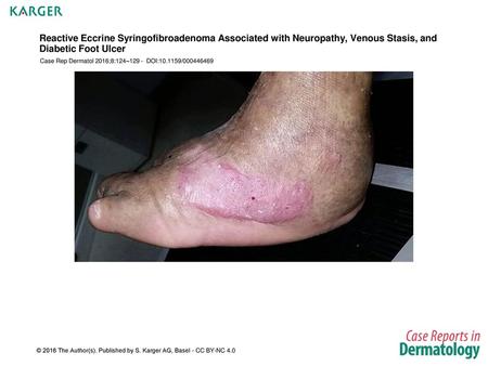 Reactive Eccrine Syringofibroadenoma Associated with Neuropathy, Venous Stasis, and Diabetic Foot Ulcer Case Rep Dermatol 2016;8:124–129 - DOI:10.1159/000446469.