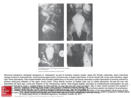 Abnormal cystograms: retrograde cystograms or “cystograms” as part of excretory urogram studies. Upper left: Ectopic ureterocele. Giant ureterocele (straight.