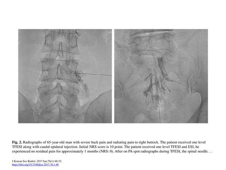 Fig. 2. Radiographs of 65-year-old man with severe back pain and radiating pain to right buttock. The patient received one level TFESI along with caudal.