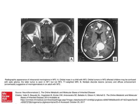 Radiographic appearance of intracranial meningioma in NF2