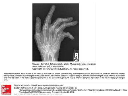 Rheumatoid arthritis. Frontal view of the hand in a 59-year-old female demonstrating end-stage rheumatoid arthritis of the hand and wrist with marked osteoporosis.