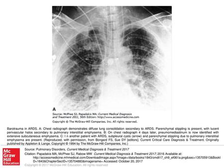Barotrauma in ARDS. A: Chest radiograph demonstrates diffuse lung consolidation secondary to ARDS. Parenchymal stippling is present, with lucent perivascular.