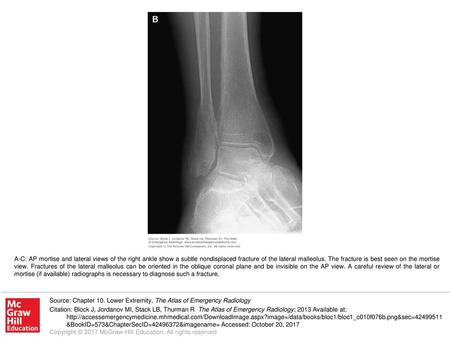 A-C: AP mortise and lateral views of the right ankle show a subtle nondisplaced fracture of the lateral malleolus. The fracture is best seen on the mortise.