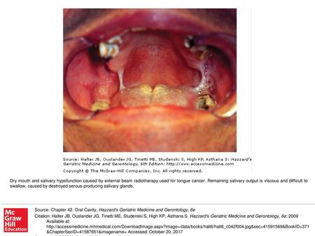 Dry mouth and salivary hypofunction caused by external beam radiotherapy used for tongue cancer. Remaining salivary output is viscous and difficult to.
