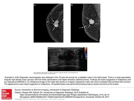 Example 6: (A,B) Diagnostic mammography was obtained in this 70-year-old woman for a palpable mass in the right breast. There is a large speculated, irregular.