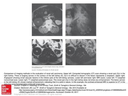 Comparison of imaging methods in the evaluation of renal cell carcinoma. Upper left: Computed tomography (CT) scan showing a renal cyst (Cy) in the right.