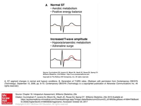 A. ST segment changes in normal and hypoxic conditions. B