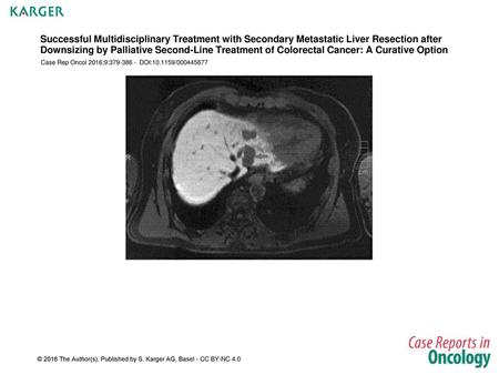 Successful Multidisciplinary Treatment with Secondary Metastatic Liver Resection after Downsizing by Palliative Second-Line Treatment of Colorectal Cancer:
