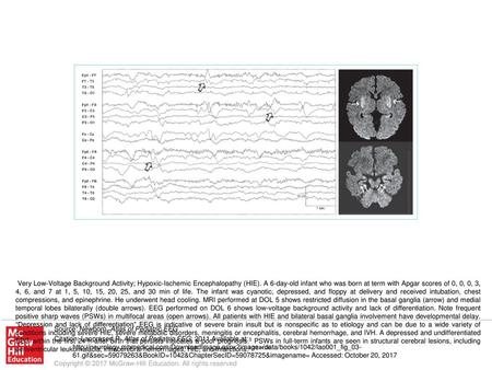 Very Low-Voltage Background Activity; Hypoxic-Ischemic Encephalopathy (HIE). A 6-day-old infant who was born at term with Apgar scores of 0, 0, 0, 3, 4,