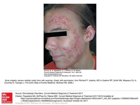 Acne vulgaris, severe nodular cystic form with scarring