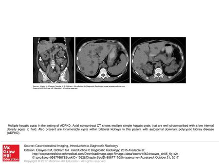 Multiple hepatic cysts in the setting of ADPKD
