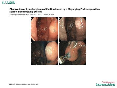 Observation of Lymphangioma of the Duodenum by a Magnifying Endoscope with a Narrow-Band Imaging System Case Rep Gastroenterol 2013;7:229-233 - DOI:10.1159/000351831.
