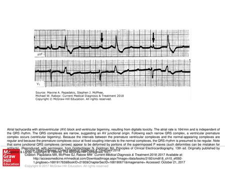 Atrial tachycardia with atrioventricular (AV) block and ventricular bigeminy, resulting from digitalis toxicity. The atrial rate is 164/min and is independent.
