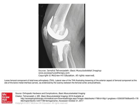 Loose femoral component of total knee arthroplasty (TKA)