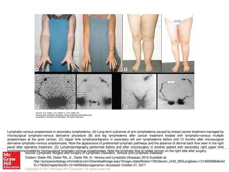 Lymphatic–venous anastomosis in secondary lymphedema