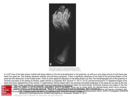 A: A DP view of the toes shows marked soft tissue edema in the foot and particularly in the great toe, as well as a very large amount of soft tissue gas.