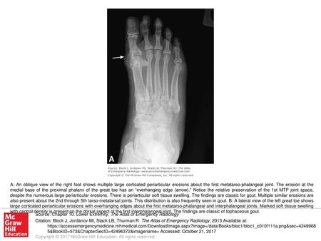 A: An oblique view of the right foot shows multiple large corticated periarticular erosions about the first metatarso-phalangeal joint. The erosion at.