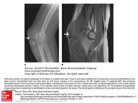 Olecranon bursitis. (A) Lateral radiograph of the elbow in a patient with gout. There is soft tissue swelling over the olecranon as well as calcifications.