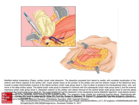 Modified radical mastectomy (Patey): axillary lymph node dissection